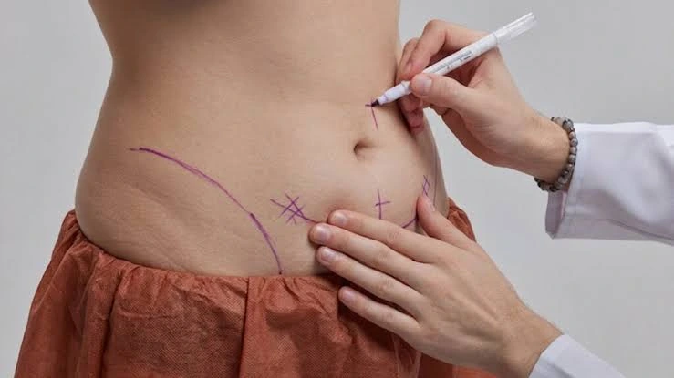 Surgeon marking the abdomen before a tummy tuck