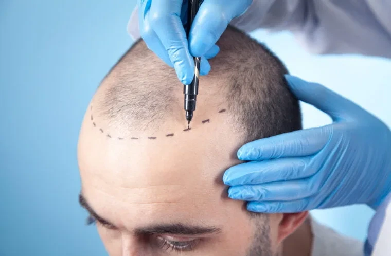 Hair transplant treatment card image