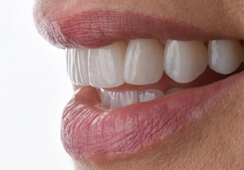 Close-up of veneers being fitted to the front teeth