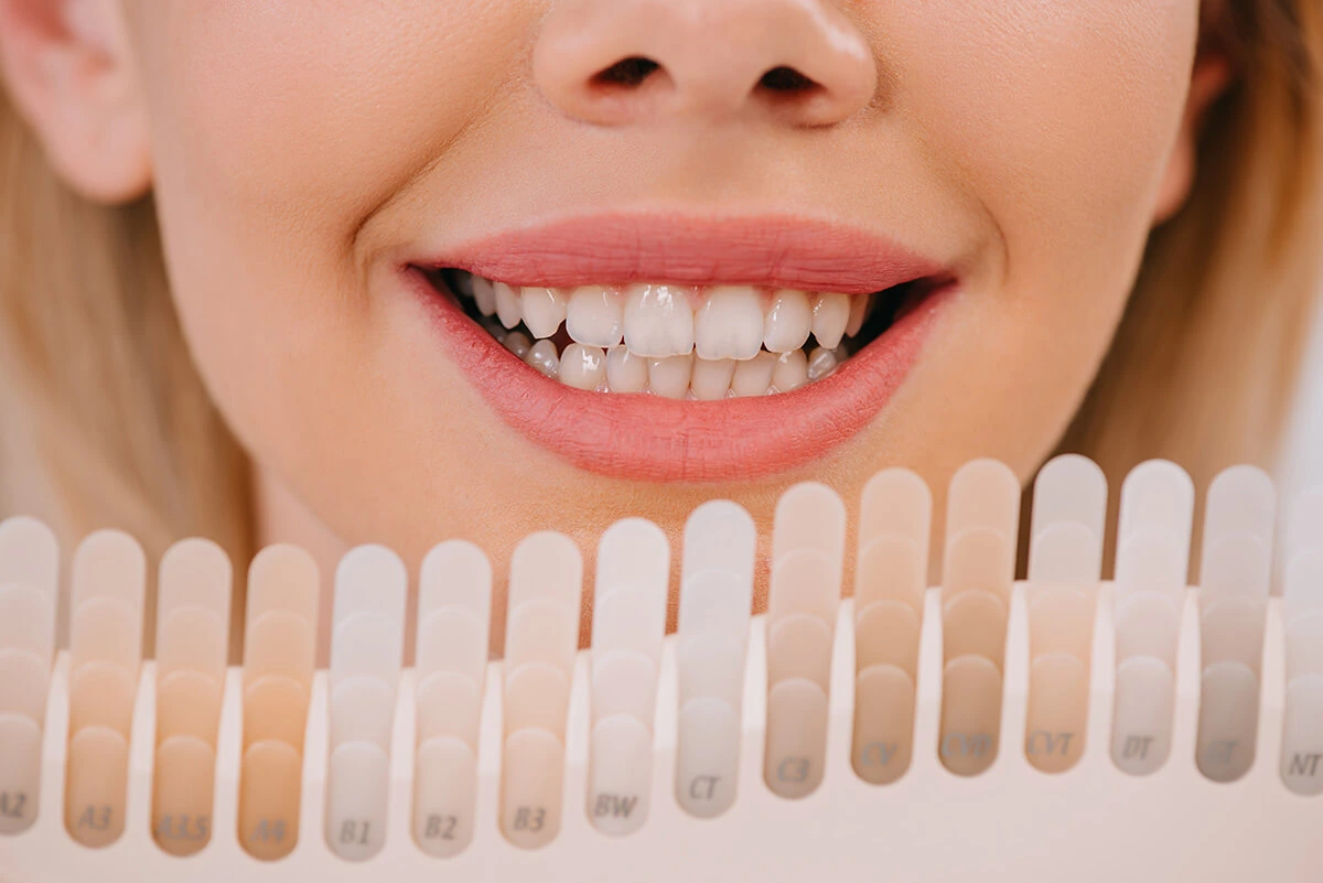 Shade guide held against teeth to match E-max veneers