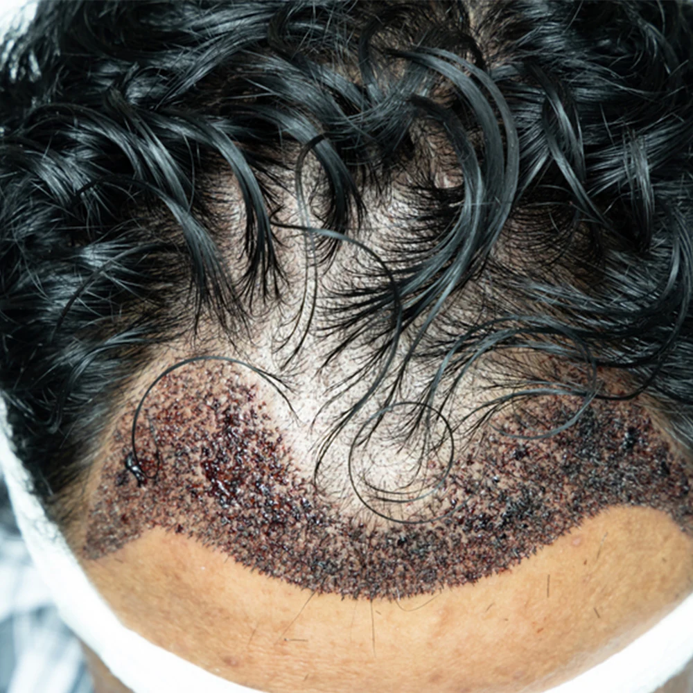 Implanted grafts on the scalp after a DHI hair transplant
