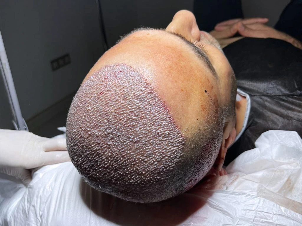 Donor area of the scalp during an FUE hair transplant