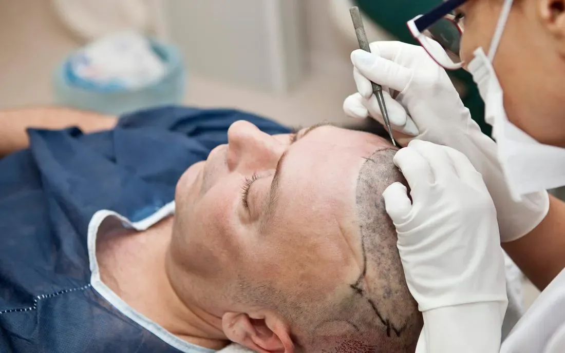 Hairline planning before the procedure