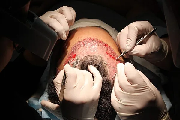 Graft extraction with microscopes