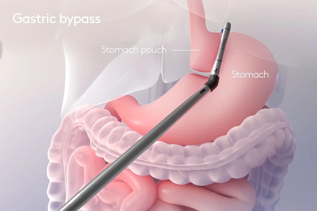 Illustration of a gastric bypass showing the small stomach pouch and the rerouted intestine