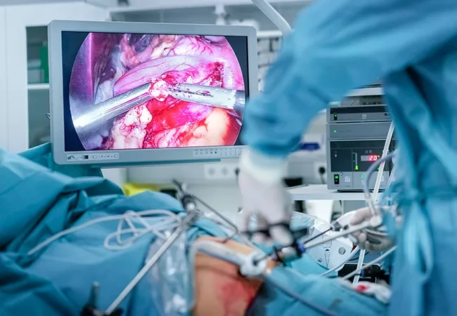 Surgeon operating laparoscopically, with the camera view on the theatre monitor