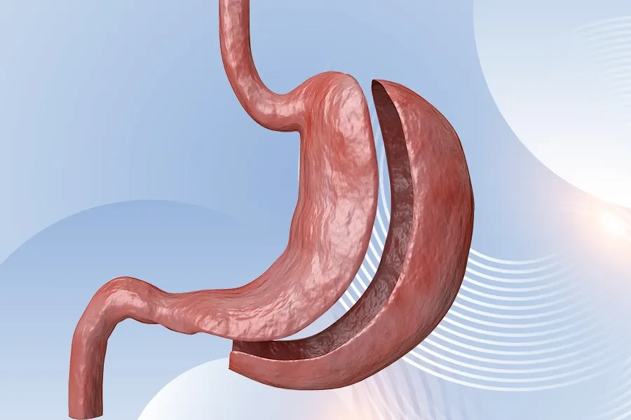 Illustration of the stomach before and after a sleeve gastrectomy