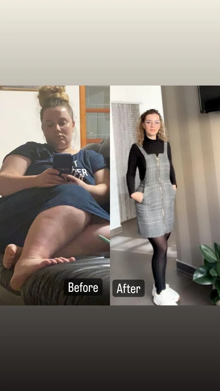 Bariatric patient before and after treatment
