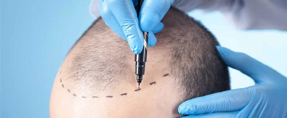 Hair Transplant
in Türkiye